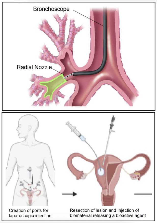 Illustration of the implantation process for a uterine device, highlighting medical device design and its application.