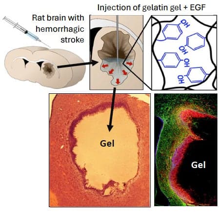 A composite image consists of a rat brain with hemorrhagic stroke, injection of gelatin gel to the brain, and lesion changes after the injection.